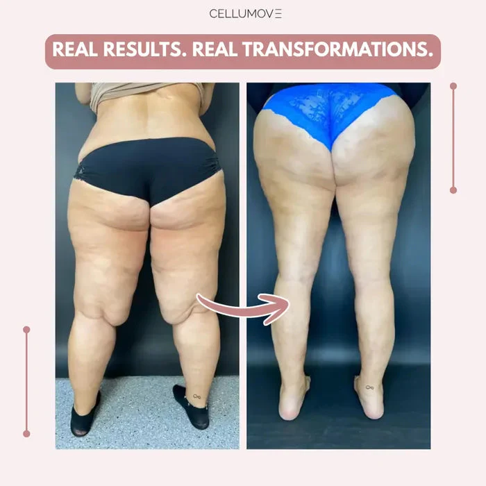 Cellumove 3D legging - say goodbye to lipedema pain and swelling naturally - Image 3