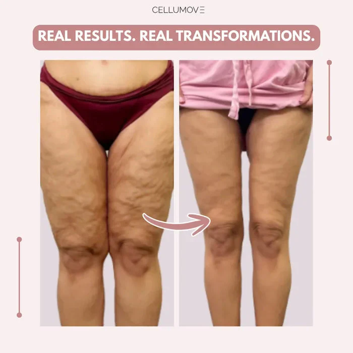 Cellumove 3D legging - say goodbye to lipedema pain and swelling naturally - Image 3