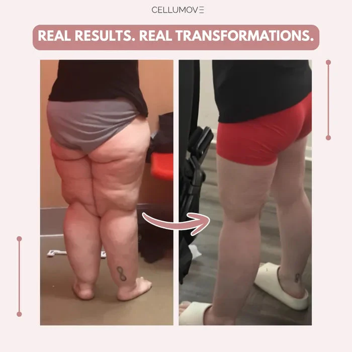 Cellumove 3D legging - say goodbye to lipedema pain and swelling naturally - Image 4