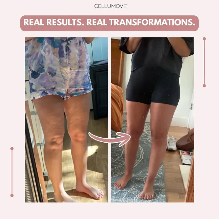 Cellumove 3D legging - say goodbye to lipedema pain and swelling naturally - Image 5