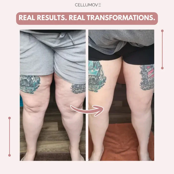 Cellumove 3D legging - say goodbye to lipedema pain and swelling naturally - Image 6