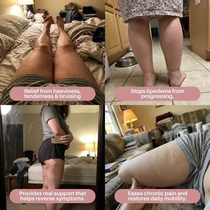Cellumove 3D Legging – Say goodbye to lipoedema pain and swelling naturally - Image 4