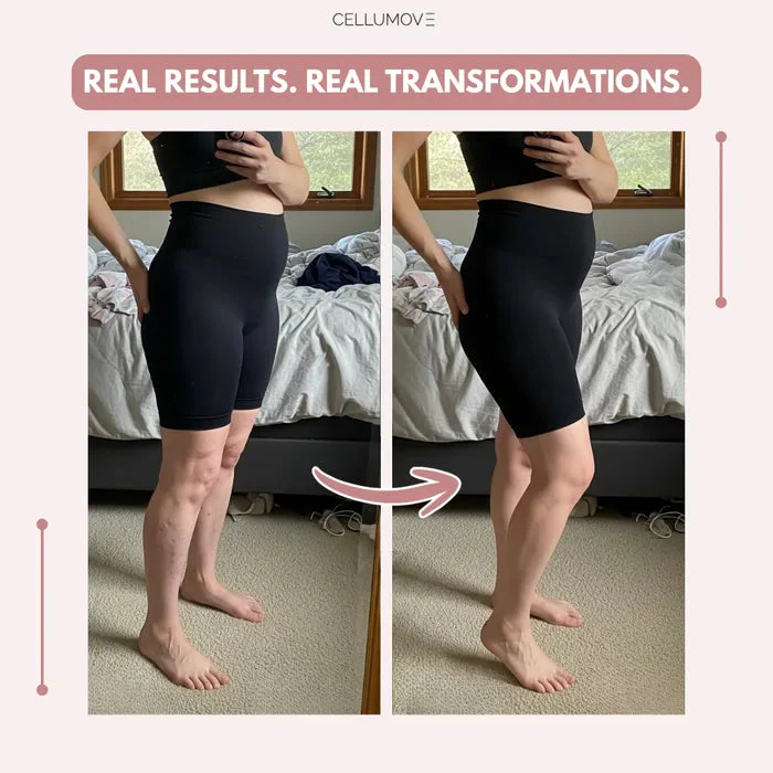 Cellumove 3D Legging – Post partum Edema - Image 3