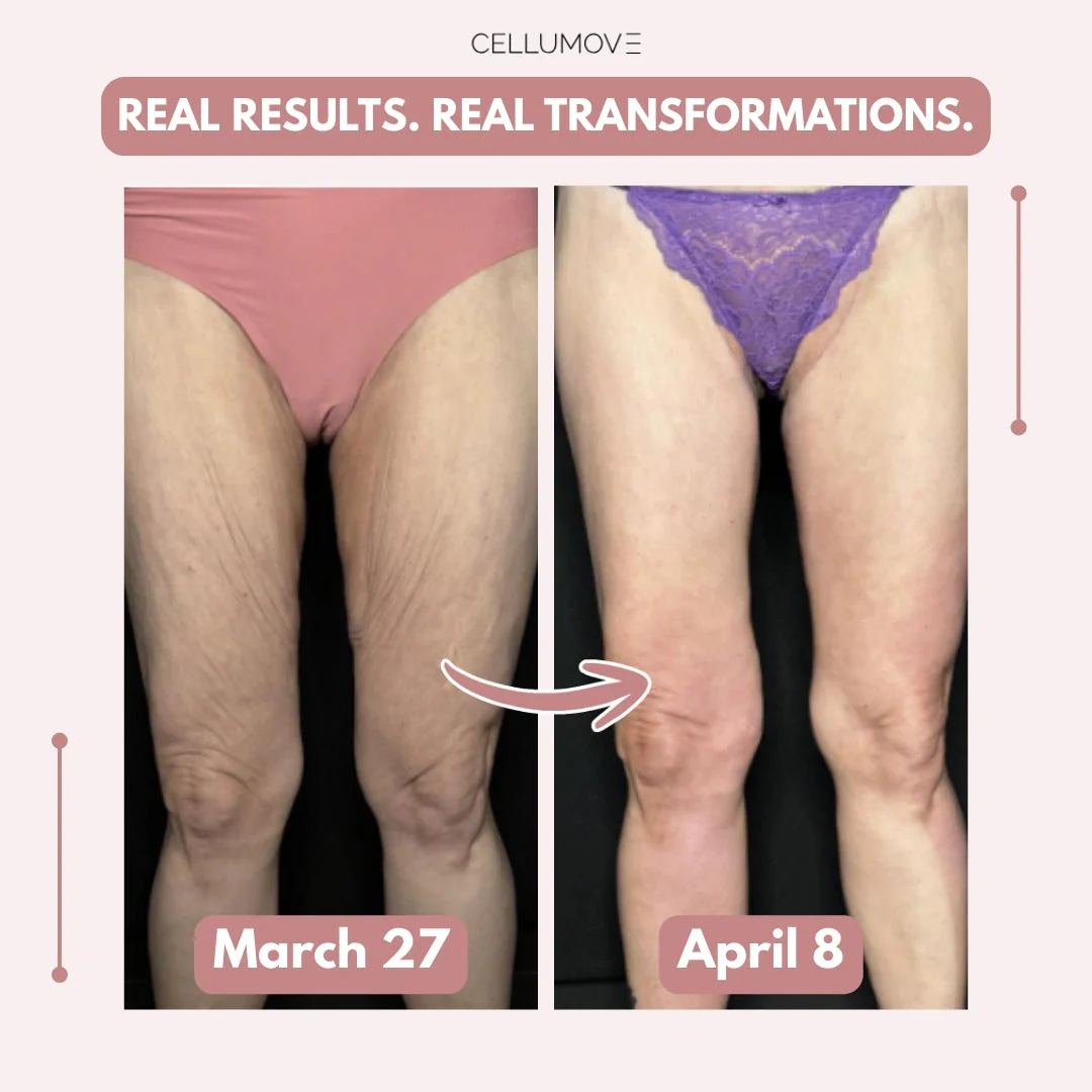 Firmer, smoother legs in 14 days — for women tired of saggy skin holding them back - Image 4