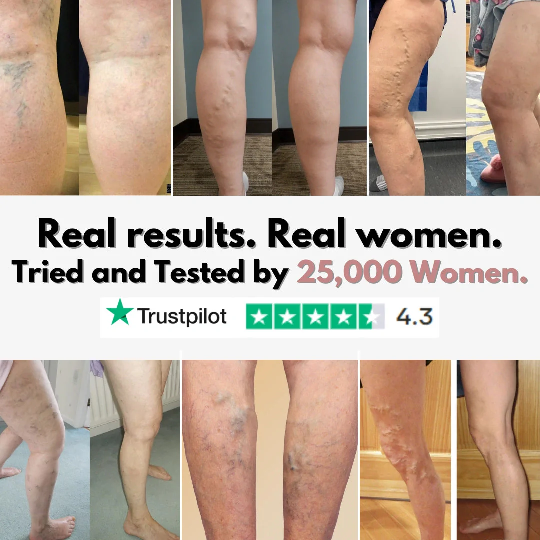 From Spider Vein & heavy legs to visible relief for healthcare workers in 14 days - Image 7